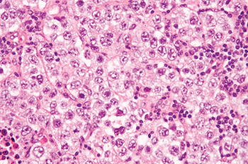 Imagen: Corte histológico del cáncer testicular (Fotografía cortesía de Nephron).